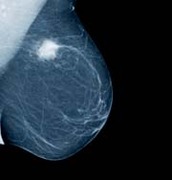 Breast Cancer related image