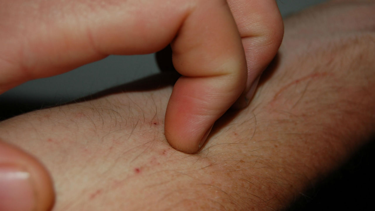 Why do diabetics develop itching arms?