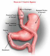 Gastric Bypass Logo