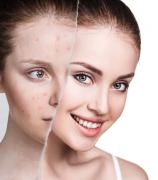 How Isotroin 20mg Capsules Can Help Clear Your Acne Logo