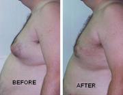 Gynecomastia / Gynaecomastia (Male Breast Enlargement ) Logo