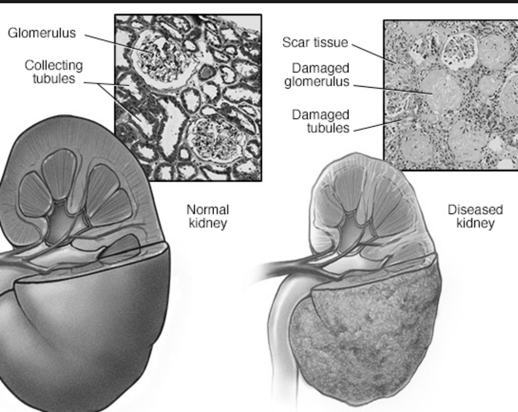 Drugs That Cause Kidney Damage