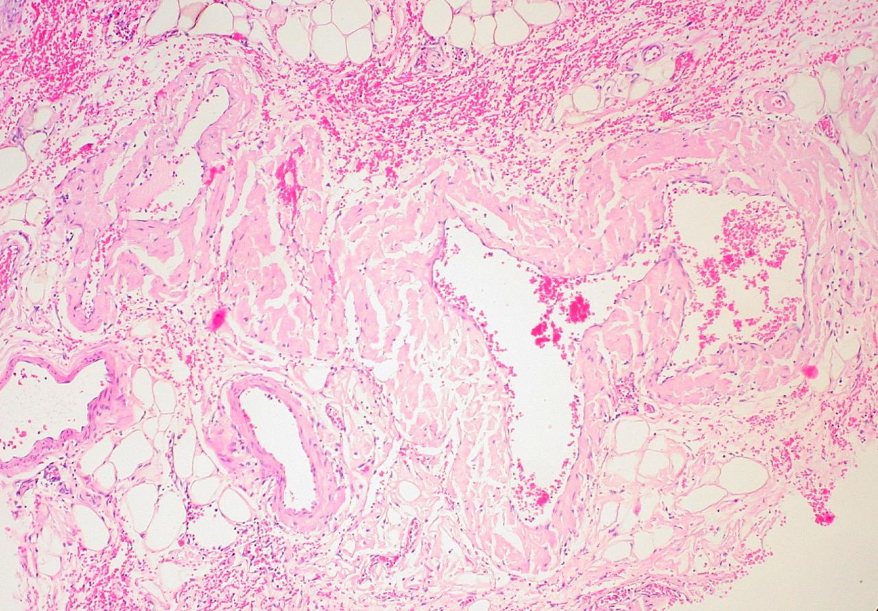 Amyloidosis - An Overview Of This Rare Disorder (And The Amyloid Hypothesis)