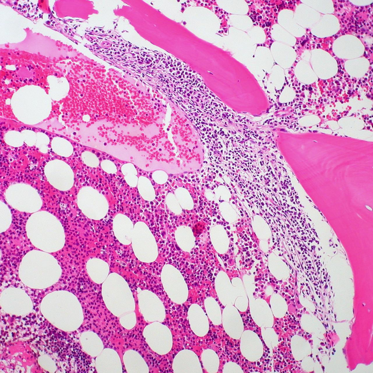 Follicular Lymphoma