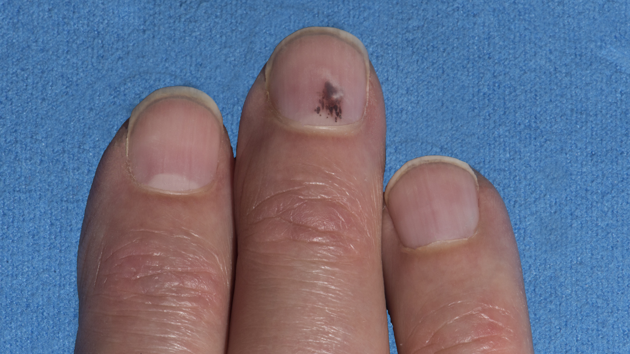 new mole or black spot on finger and growing : r/skincancer