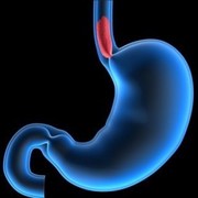 information on gastroesophageal reflux disease (GERD)