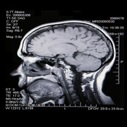 Multiple Sclerosis  related image