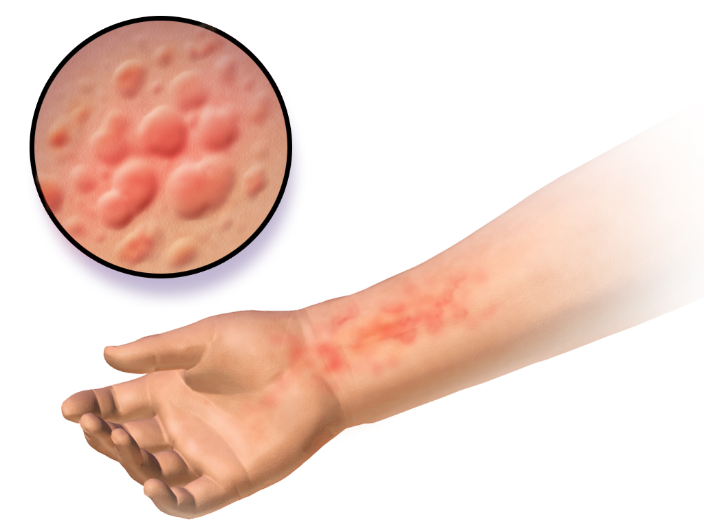 Is it Psoriasis or Eczema?