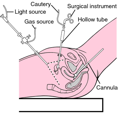 Recovering From Laparoscopy