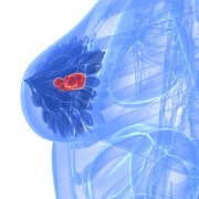 uncertainty accompanies diagnosis of breast cancer