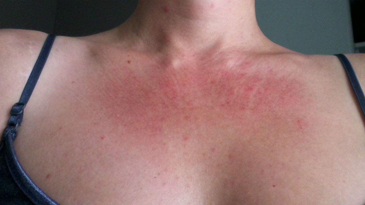 My Itchy Journey Overcoming 10 Years Of Misdiagnosed Skin Allergies 