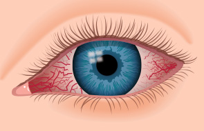 eye redness question
