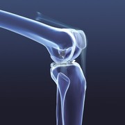 patients with hip or knee replacements have higher risk for heart disease