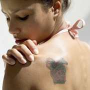 tattoo-removal