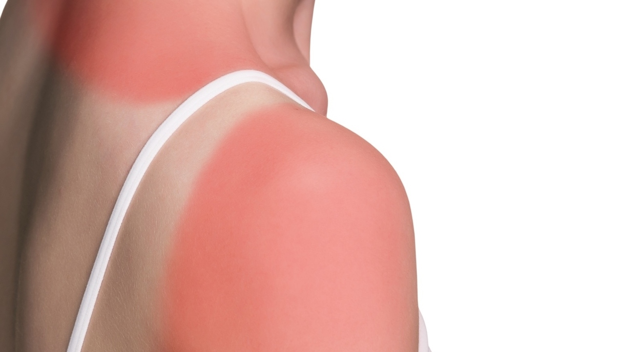 Try These 8 Natural Remedies to Soothe Your Sunburn