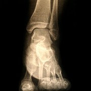 psuedogout is like gout but caused by CPPD