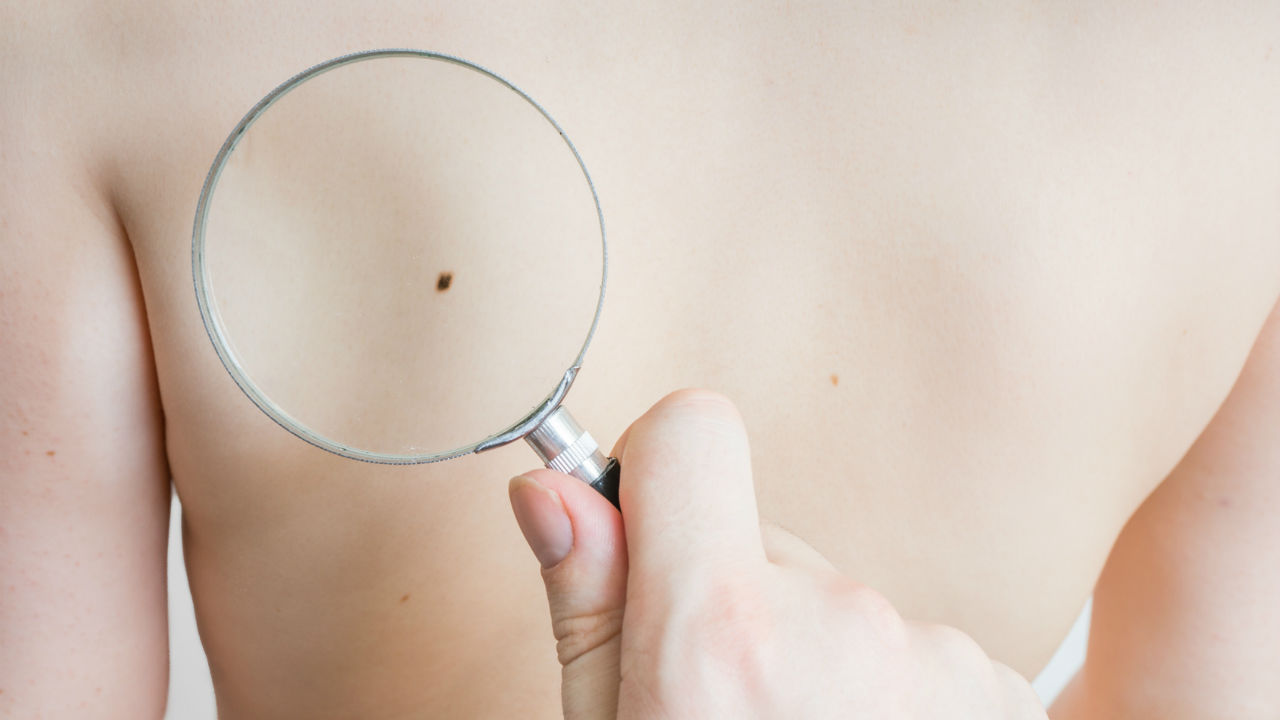 Itchy Mole? Some Cases of Skin Cancer May Itch