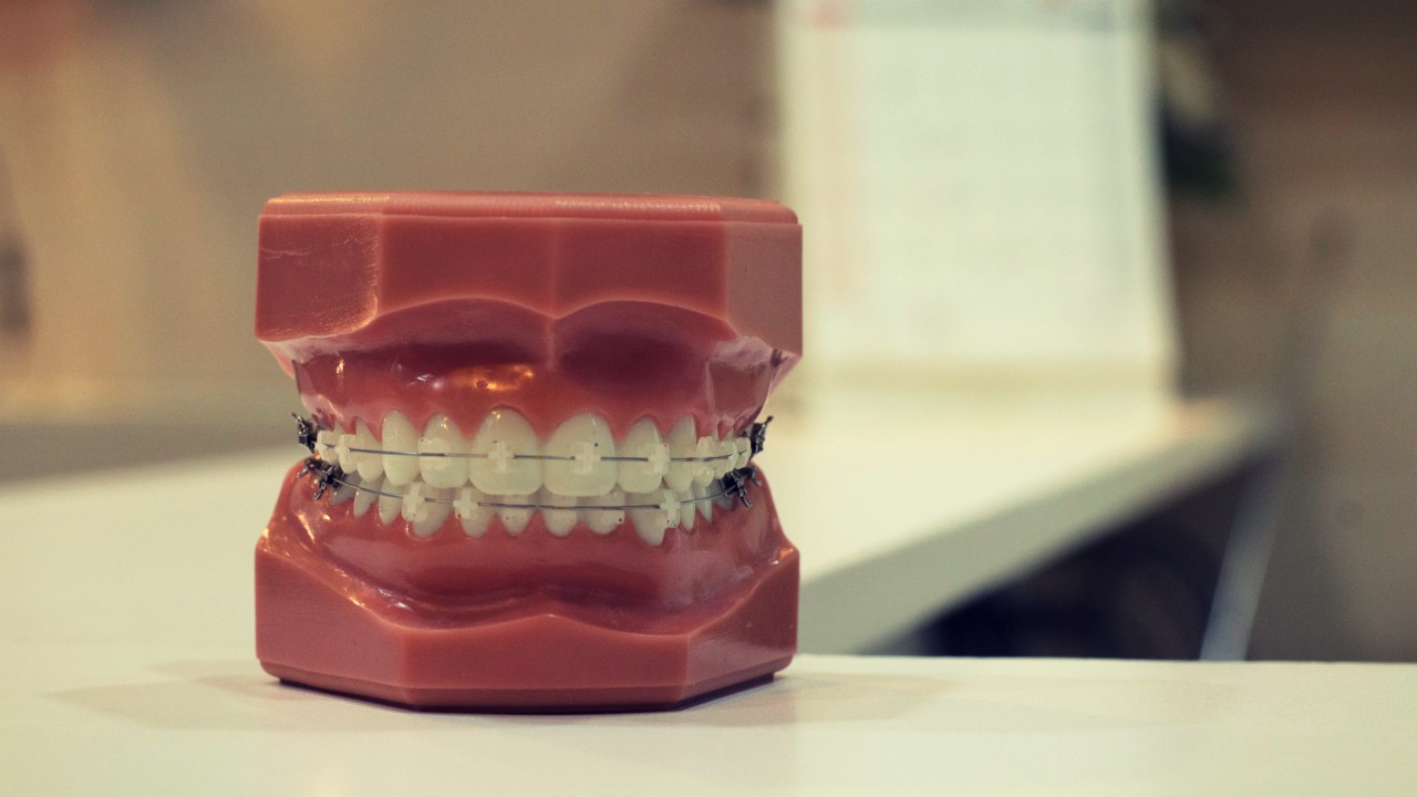10 Struggles Every Woman With Braces Had to Endure