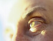 Diabetic Retinopathy related image