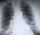 Lung Cancer  related image